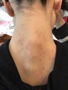 大椎を中心に熱で皮膚が炎症しています。