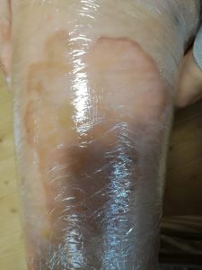 湿潤療法